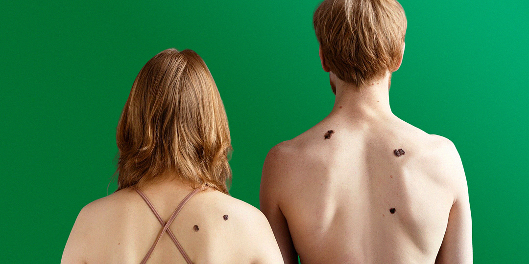 Внимание к коже: самоосмотр родинок по правилу ABCD(E) от врача-дерматолога