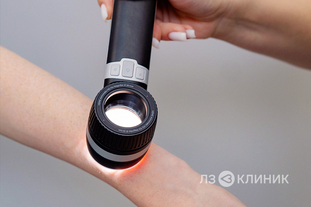 Дерматоскопия — это неинвазивный метод диагностики новообразований кожи с помощью многократного увеличения. Она безболезненна и значительно повышает точность раннего выявления меланомы.