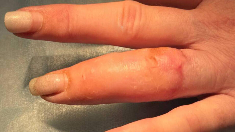     Женщина оторвала палец, зацепившись кольцом за штырь t.me/Московская медицина