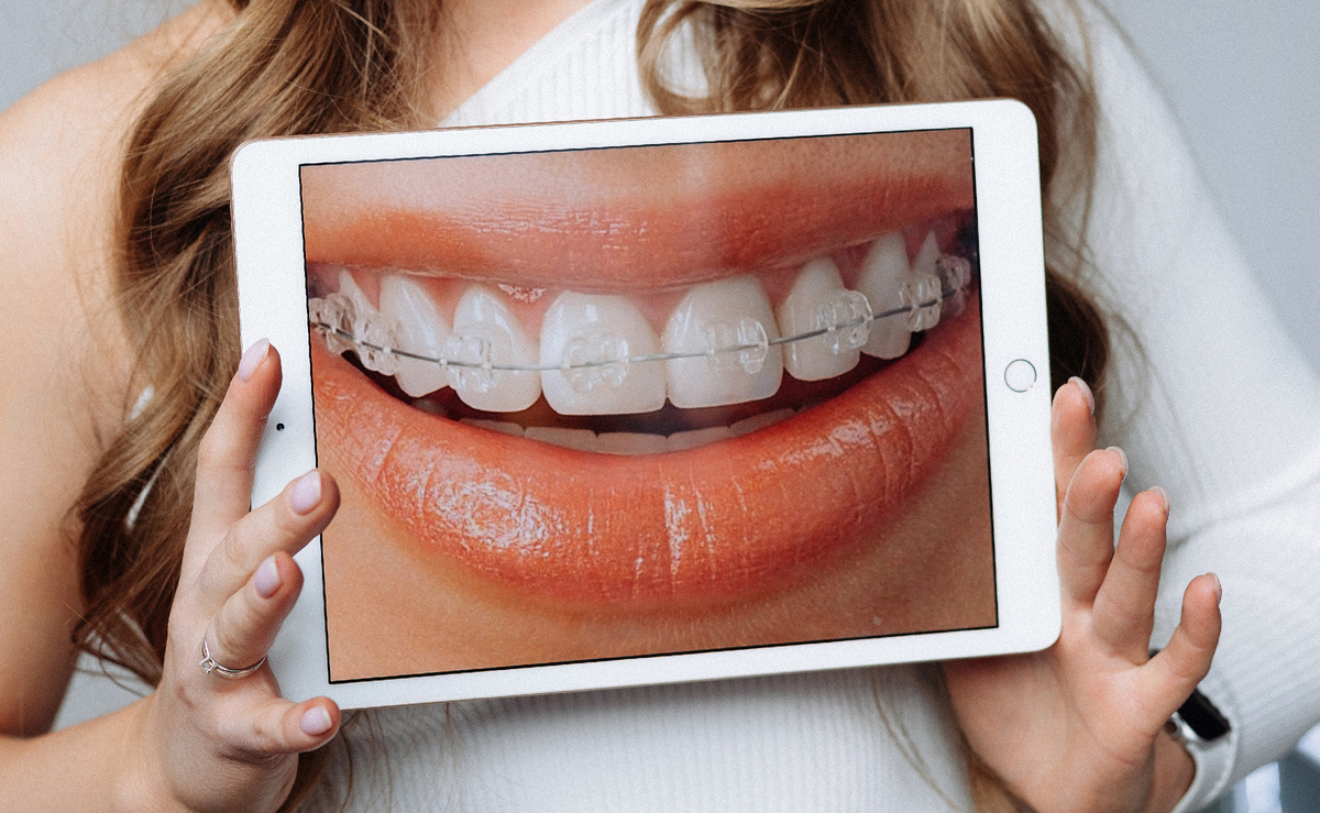 Керамические брекеты — это красиво!