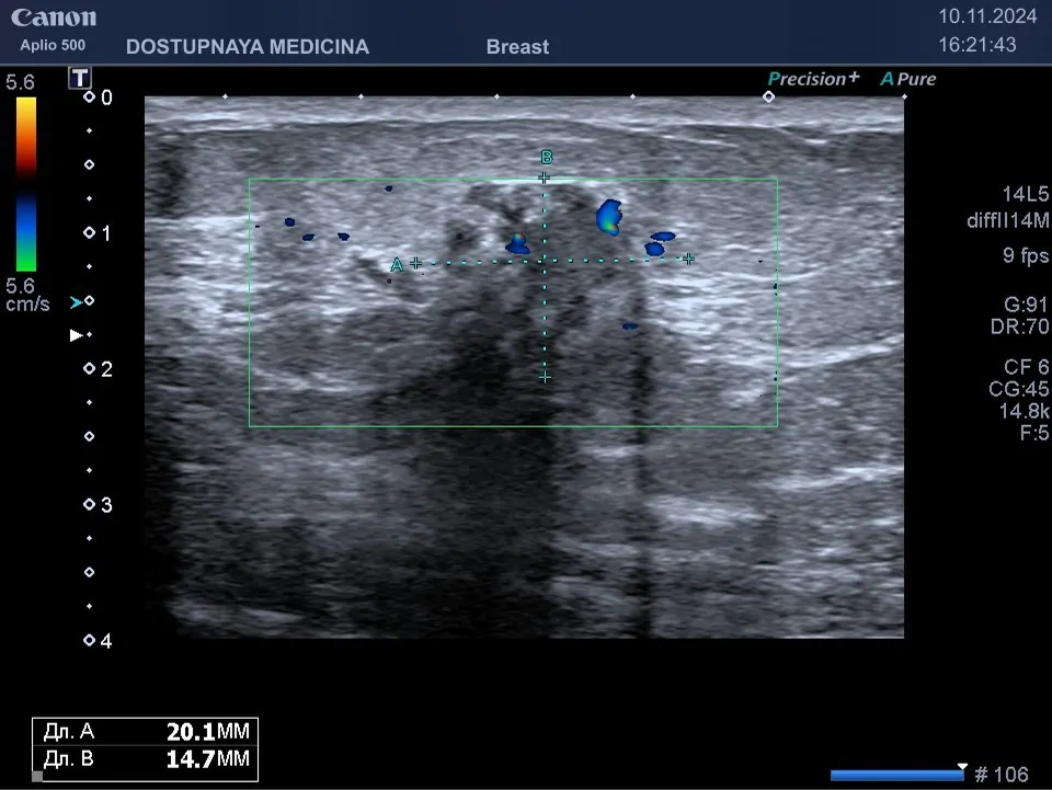 Клинический пример №1: впервые выявленное у 50-летней женщины гипоэхогенное образование спикулообразной формы, с нечётким и неровным контуром, с вертикальной пространственной ориентацией, с единичными локусами кровотока в режиме ЦДК, дающее дорсальную акустическую тень, категория BI-RADS V. Рак молочной железы затем подтверждён гистологическим исследованием после трепан-биопсии опухоли.