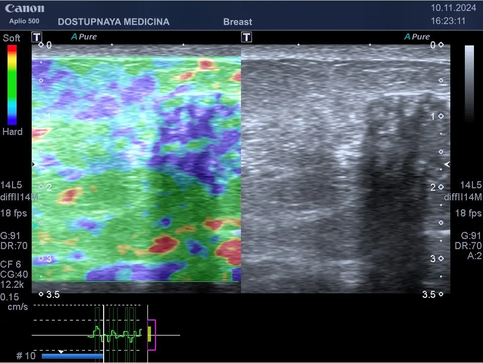 Клинический пример №1: опухоль у той же пациентки, при проведении компрессионной эластографии образования молочной железы, выполненной на УЗ-аппарате CANON (TOSHIBA) APLIO-500, картирование образования однородное, синего цвета, соответствует 4-му типу — по шкале Ueno, незначительно больше по размерам с серошкальным изображением. Эластографическая картина образования соответствует категории BI-RADS V, установленной при выполнении УЗИ в В-режиме.
