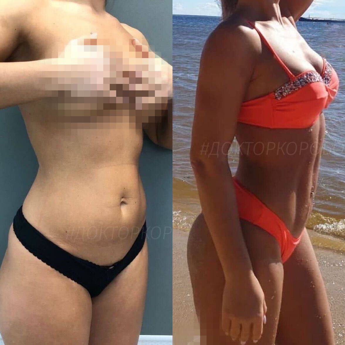 Липосакция живота с прорисовкой спортивных линий; липосакция пояснично-боковых зон для формирования талии.