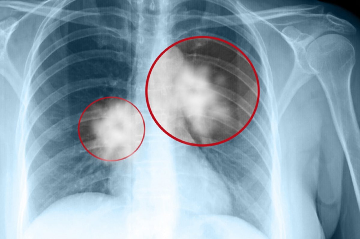 4 необычных признака рака лёгких