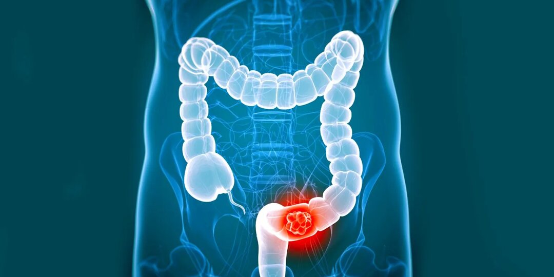 5 необычных симптомов рака кишечника