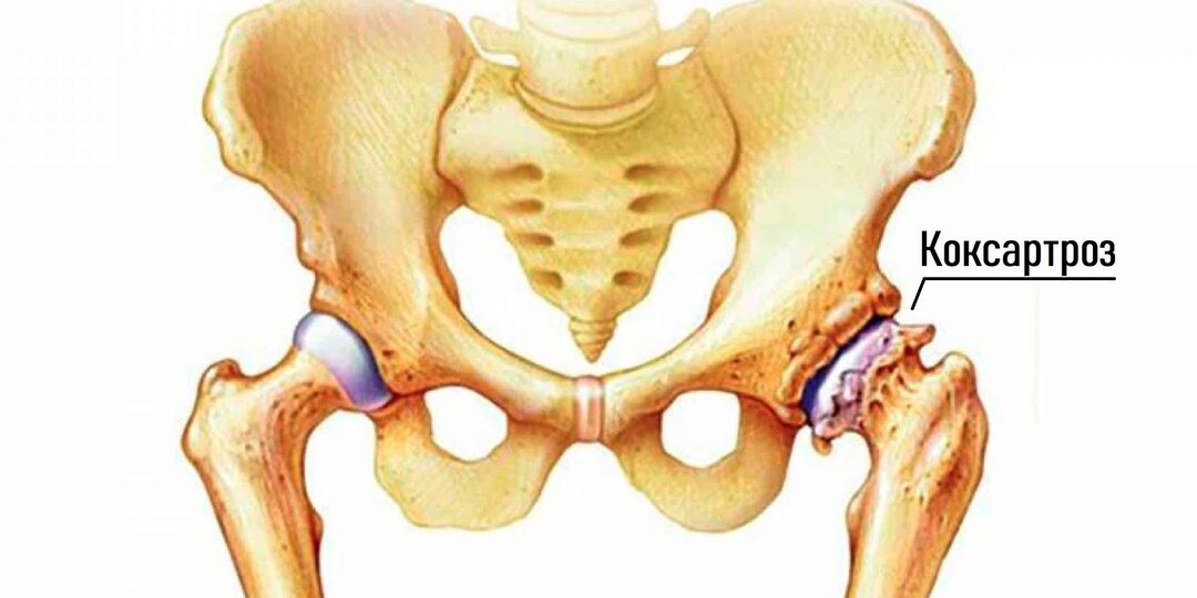 10 причин коксартроза тазобедренного сустава: почему разрушается сустав и как остановить процесс до операции