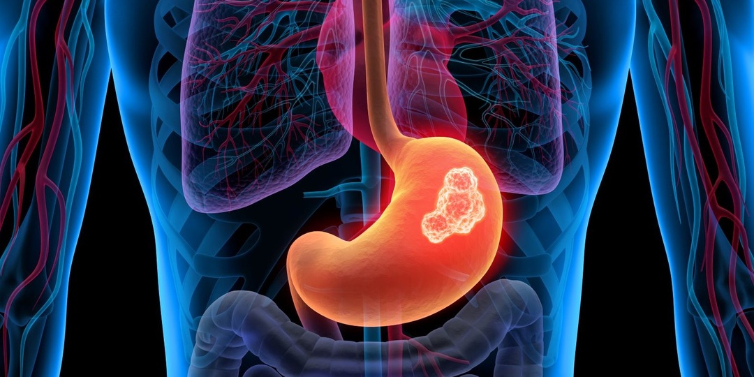 5 ранних симптомов рака желудка