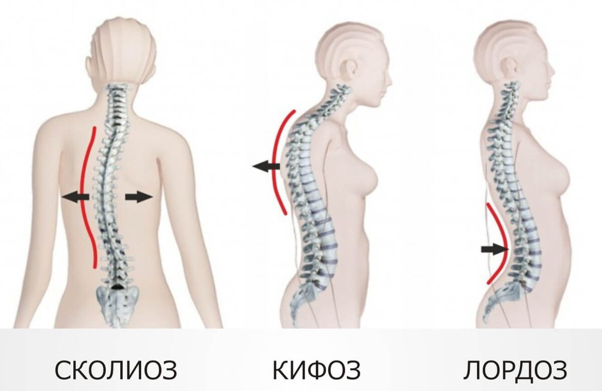    Сколиоз, кифоз и лордоз. Источник изображения: old-lekar.com