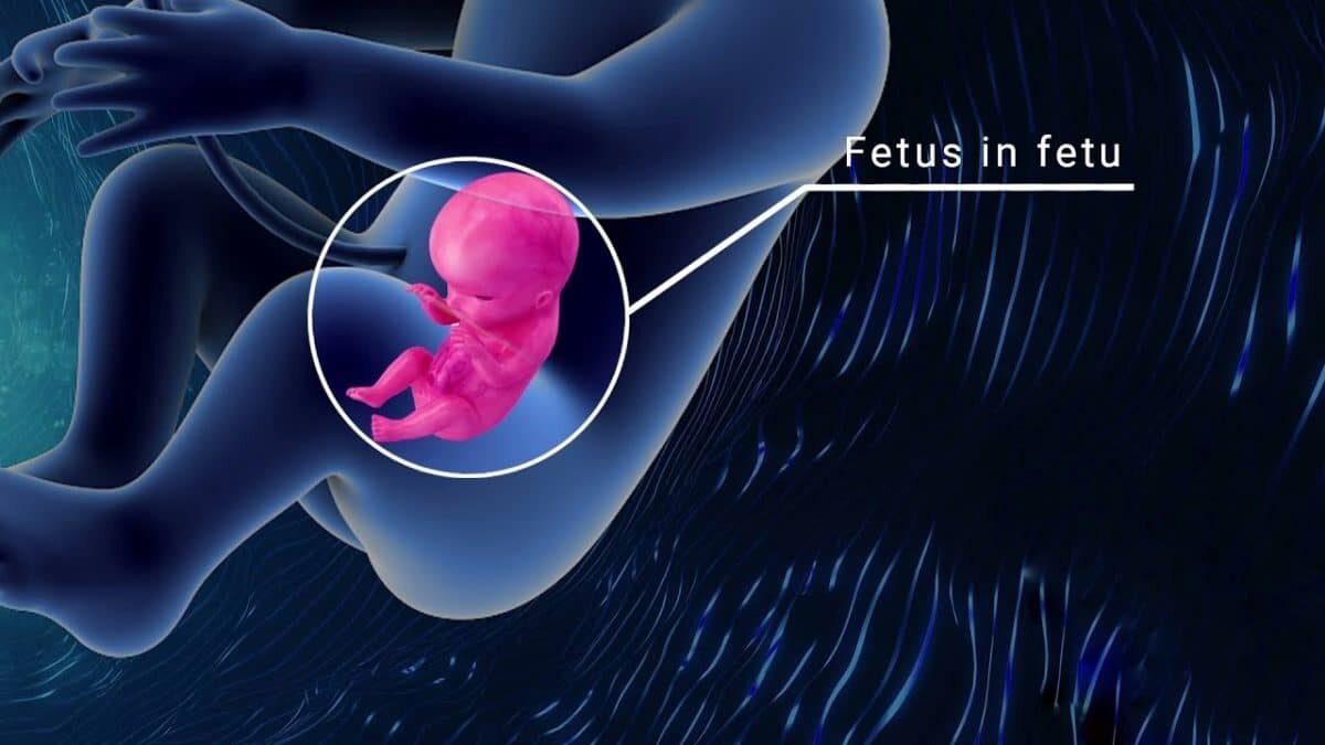    Патология «плод в плоде» (fetus in fetu) / © Fetalist