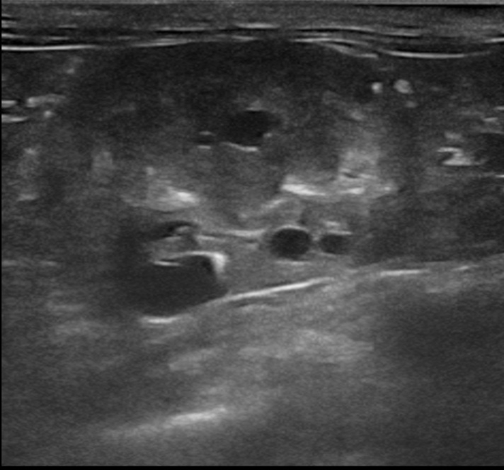 На УЗИ видны маленькие, но заметные кисты в почки