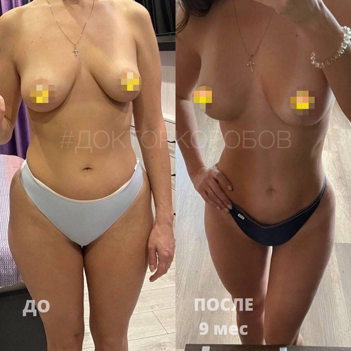 Подтяжка и липофилинг молочных желёз; липосакция живота, пояснично-боковых зон, внутренней и внешней поверхности бёдер. Результат спустя 9 месяцев после операции
