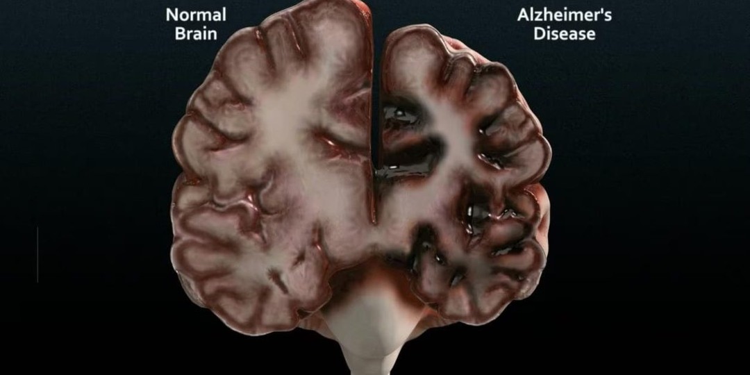 3 опасных симптома болезни Альцгеймера