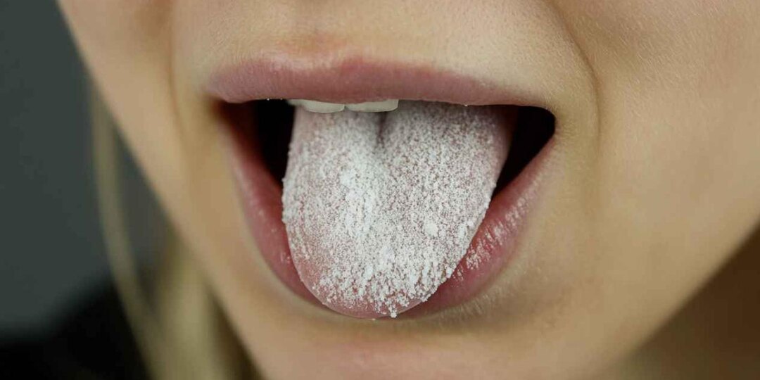 Врач объяснил, что значит белый налёт на языке