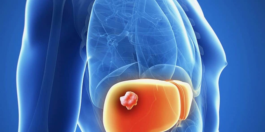 5 скрытых признаков рака печени