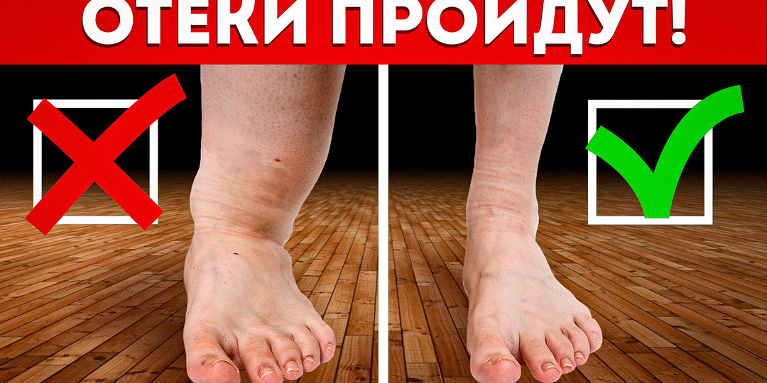 Врач объяснил, что значит отёчность ног