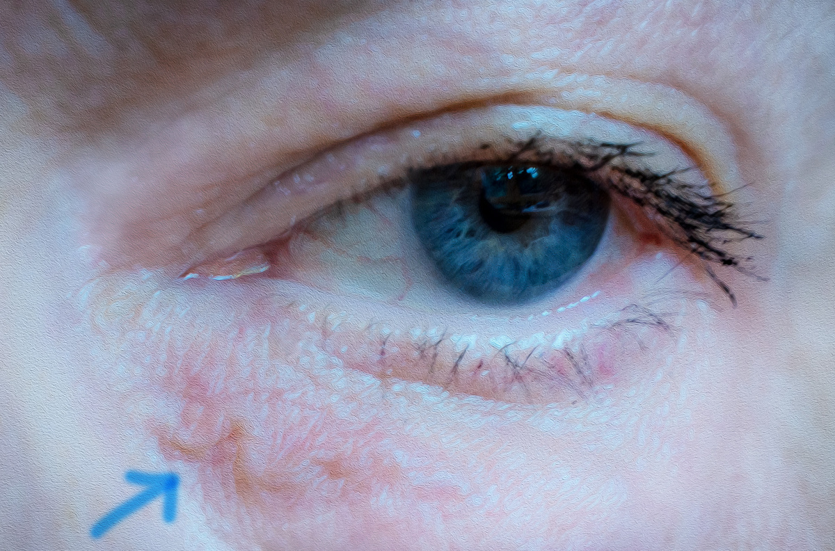 Вот такой зверь под глазом