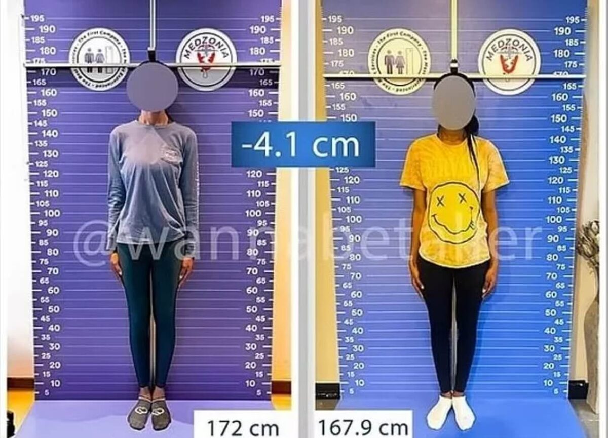    Результат укорачивания ног в Турции. Источник фотографии: odditycentral.com