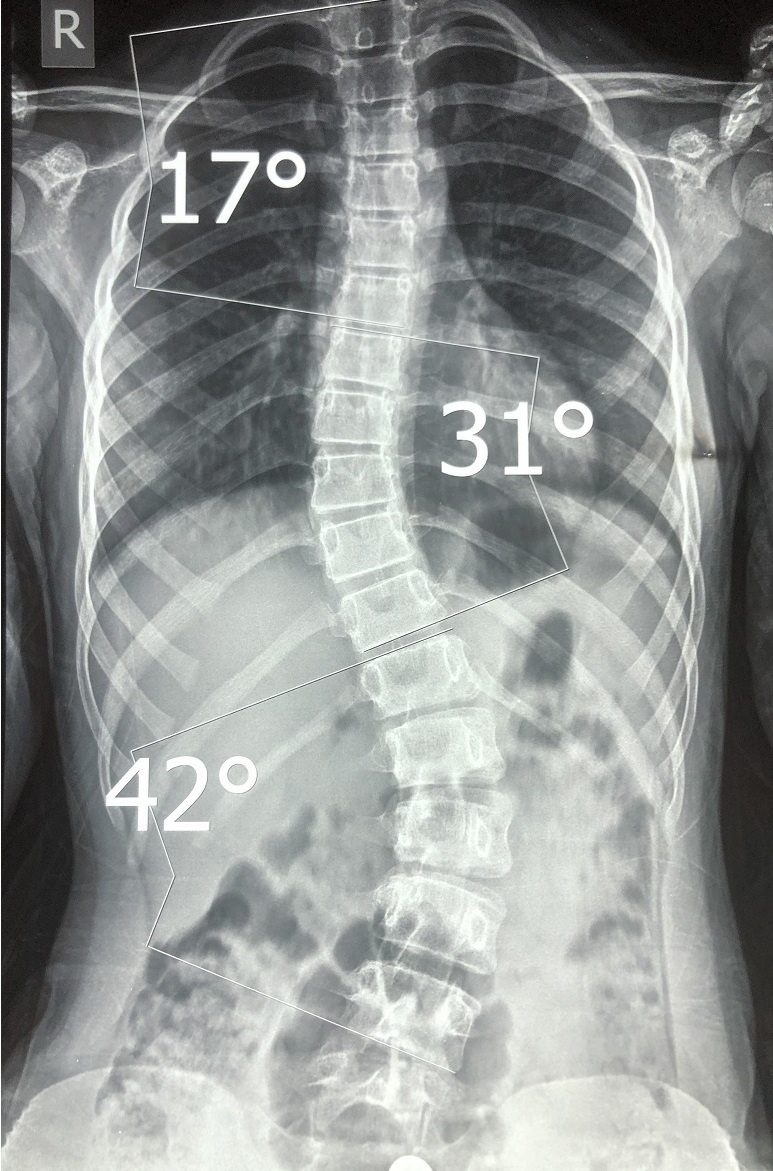 Рентгенограмма позвоночника прямая проекция. Сколиоз 3 степени по Чаклину. 