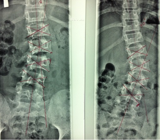 Рентгенограмма позвоночника прямая проекция лежа и стоя. Нефиксированный сколиоз.