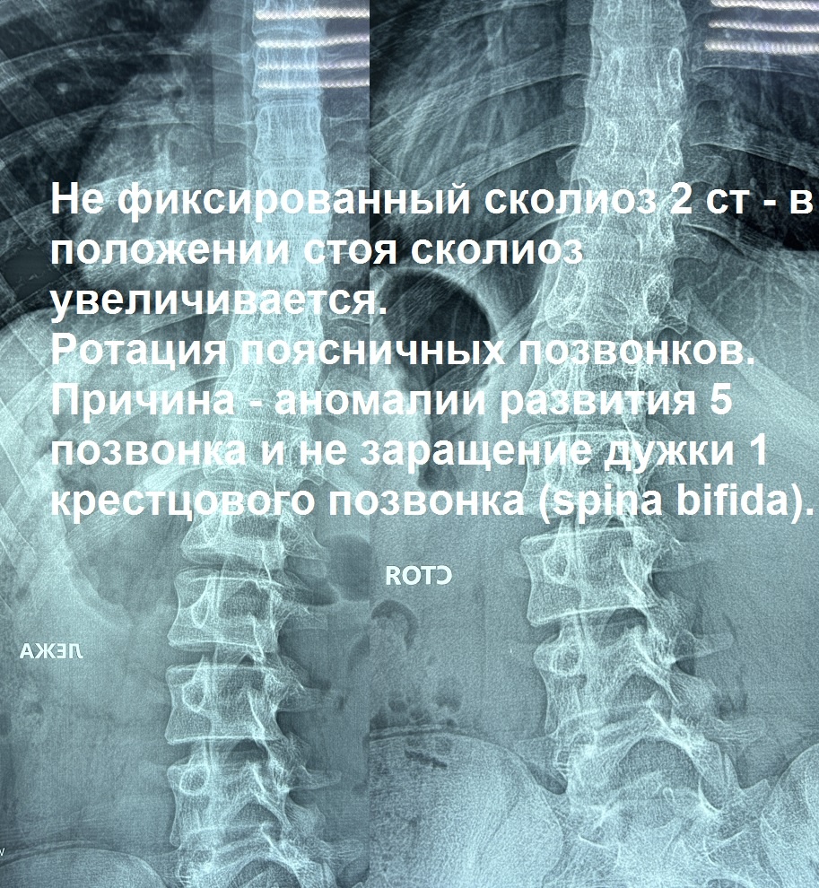 Рентгенограмма позвоночника прямая проекция неоссифицированные апофизарные зоны роста гребней подвздошных костей. Признак возможного прогрессирования Риссера. 
