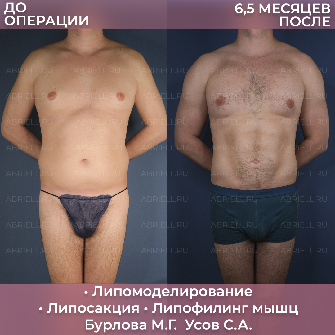 Мужская липосакция живота и боков и липофилинг мышц. Пластические хирурги Бурлова Мария Григорьевна и Усов Семен Александрович 