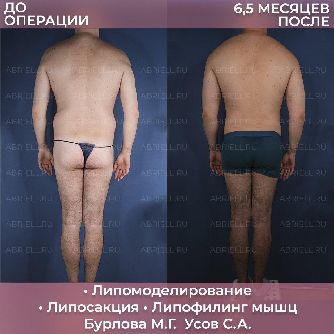 Липомоделирование тела. Липоскульптура в Санкт-Петербурге 