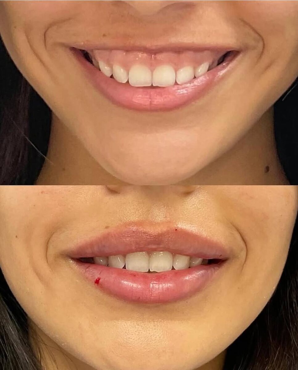 Результат БОТУЛИНОТЕРАПИИ 