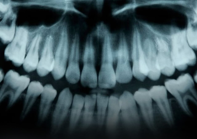 Снимок зубов