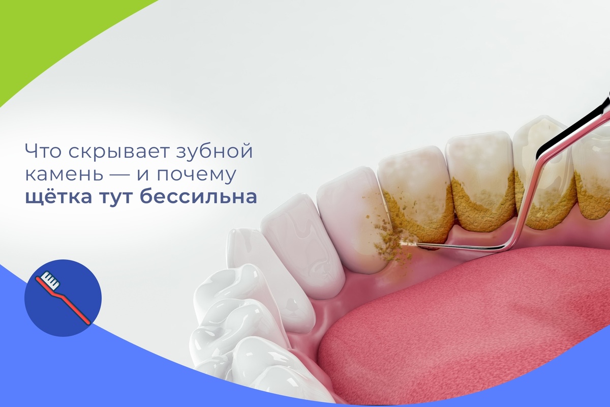 Что скрывает зубной камень — и почему щётка тут бессильна

Снаружи он выглядит как «ободок» у десны. А под ним часто прячется то, что не видно в зеркало.

Что прячет камень:

Воспаление дёсен. Постоянный источник бактерий поддерживает кровоточивость и отёк.

Кариес у шейки зуба. Минерализованный налёт закрывает дефект — он растёт «под прикрытием».

Пародонтальные карманы. Там накапливается биоплёнка, появляется неприятный запах и подвижность зубов.

Риск рецессии. Десна «уходит», оголяя чувствительную шейку и корень.

Домашняя чистка не снимает зубной камень — он уже «приклеен» к эмали. Скребки из интернета и жёсткое трение только травмируют десну и эмаль.

Как решаем в «Вита Дент»: профессиональная гигиена (ультразвук + AirFlow + полировка) бережно снимает камень и пигментацию, возвращает свежесть и защищает от скрытых проблем. После — даём простой план ухода, чтобы результат держался дольше.

Запишитесь на гигиену раз в 6 месяцев — это самый лёгкий способ обезопасить улыбку от больших лечений завтра.

Для пациентов «ВитаДент» действует акция: Профессиональная чистка «Полный комплекс для своих» по цене 4950 рублей.
📍 Вита Дент, м. Бабушкинская
🌐 vitadentmsk.ru
📞 +7 (499) 229-33-38