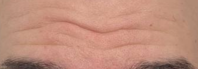 морщины у мужчин часто возникают из-за переработок 