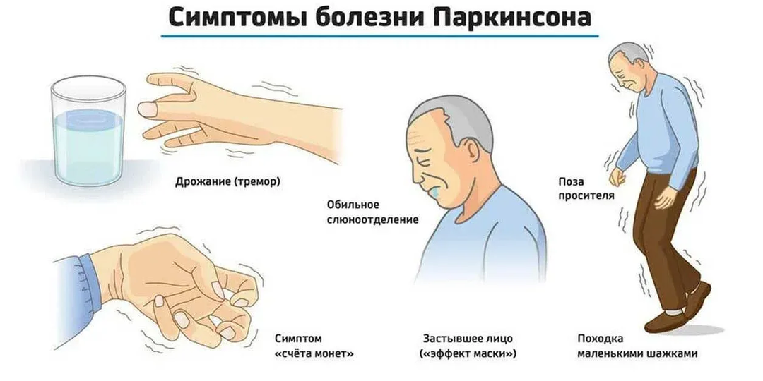 4 ранних признака болезни Паркинсона