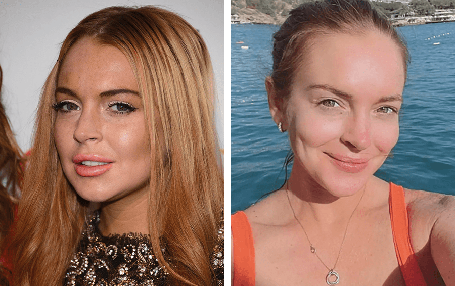 Линдси Лохан до и после удаления филлеров