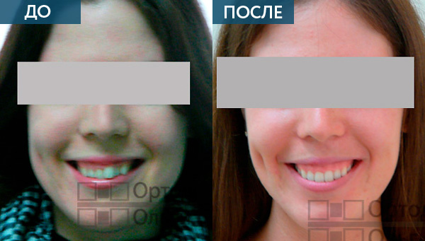 Лечение брекетами до и после
