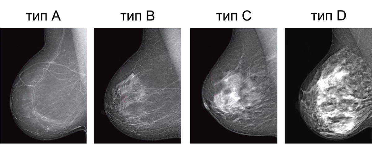 Типы плотности молочных желез ACR