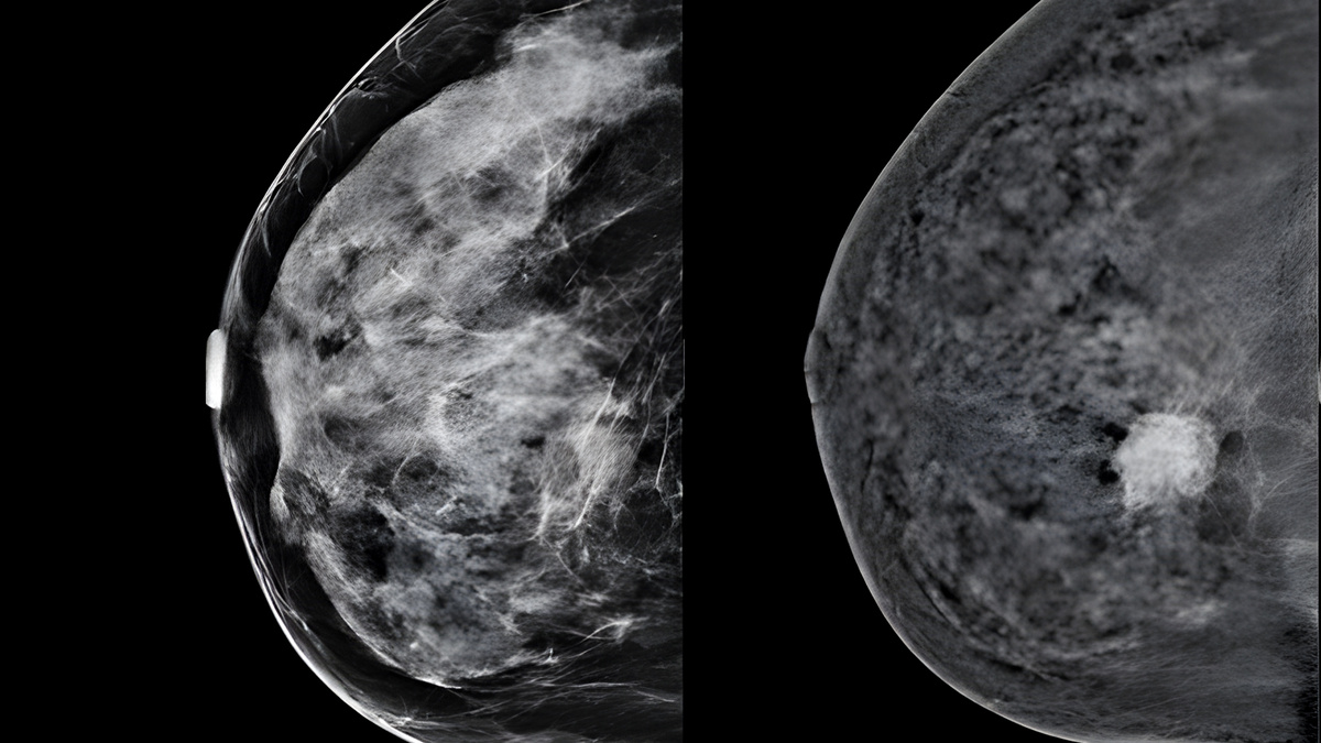 Слева стандартный снимок железы высокой плотности. Справа комбинированное изображение этой же железы, полученное с помощью двуэнергетической контрастной маммографии. На снимке отчетливо видно образование, незаметное на стандартной маммографии. 