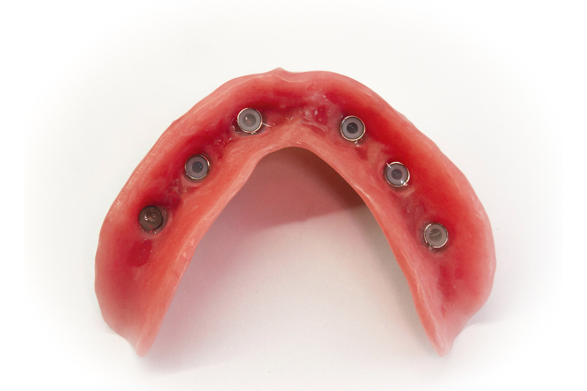 Зубной протез на имплантах на шаровидных абатментах.