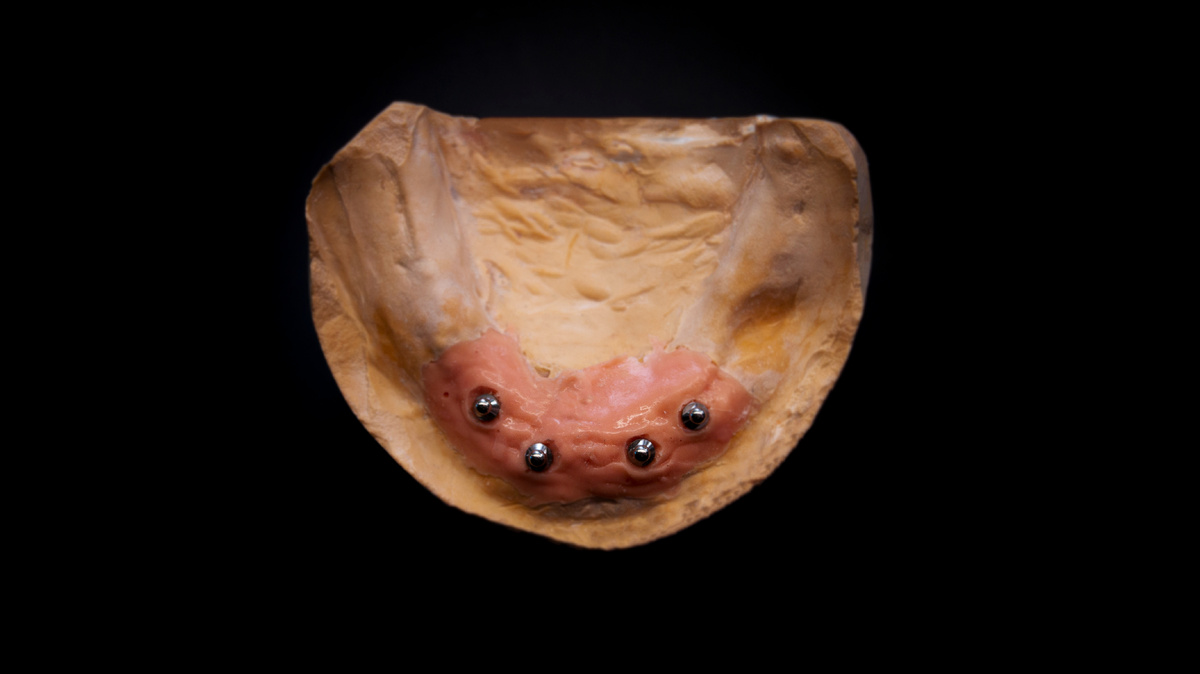 Шаровидные абатменты.