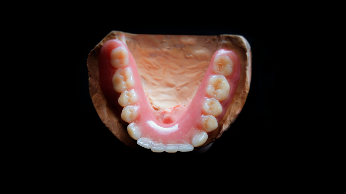 Зубной протез на имплантах на шаровидных абатментах.