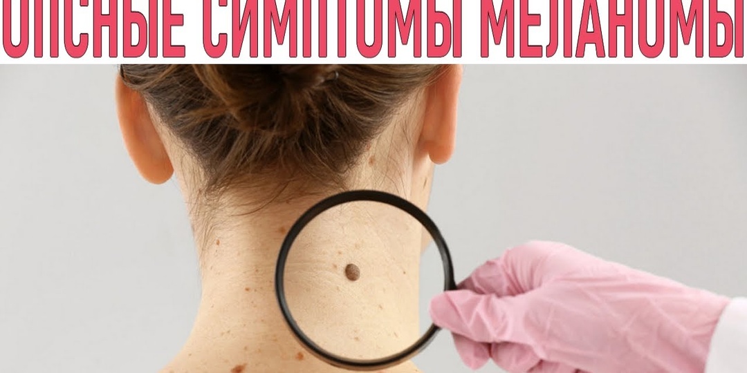 3 первых симптома меланомы