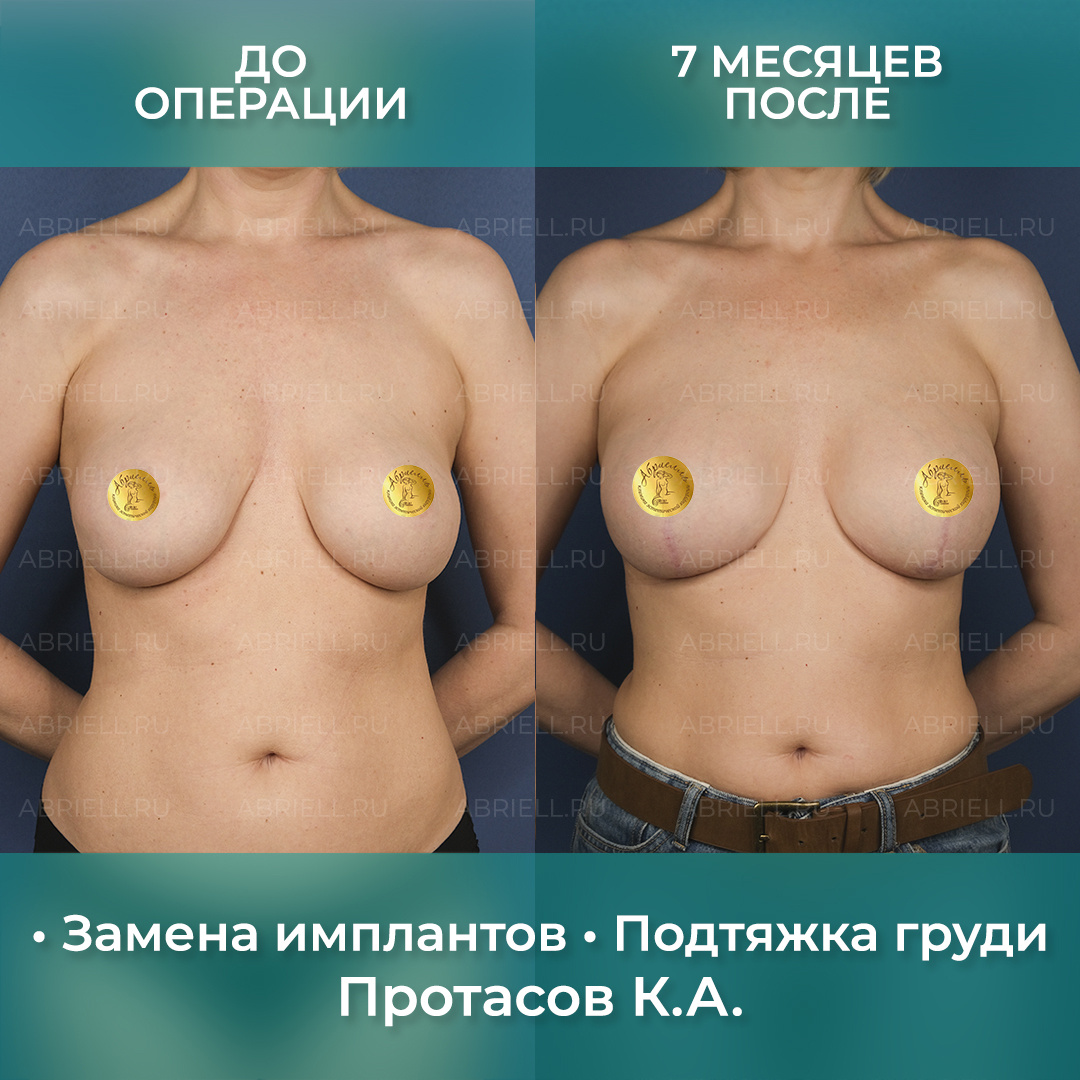 Замена имплантов. Реэндопротезирование груди с подтяжкой. Протасов Кирилл Андреевич Пластический хирург в Санкт-Петербурге.