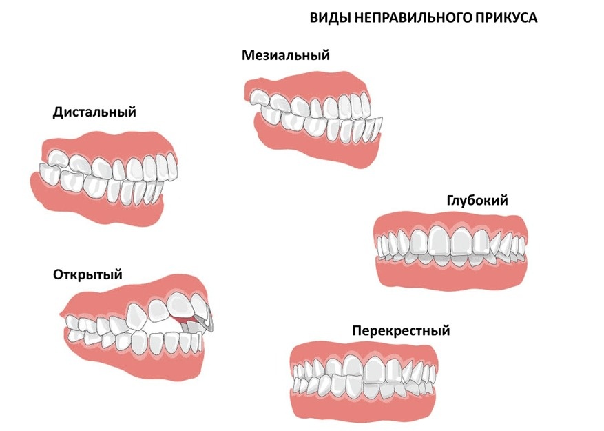 Вот так выглядит неправильный прикус