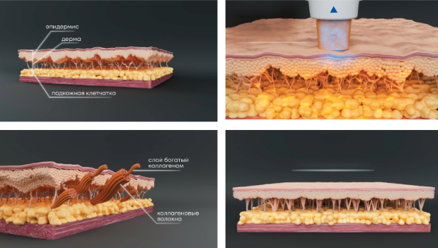 Принцип работы RF-лифтинга в коже