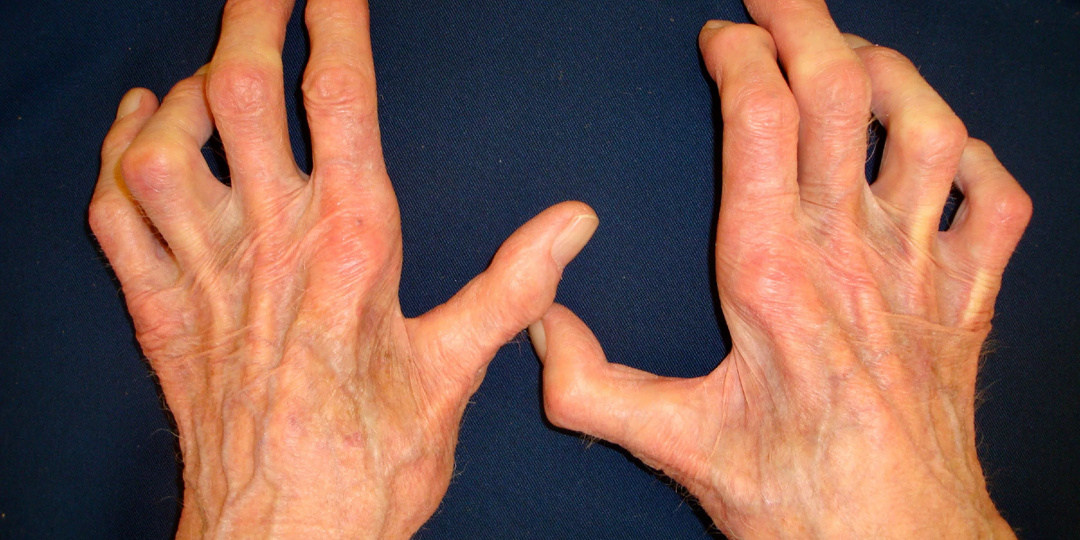 Скрючивание пальцев: почему пальцы искривляются и как остановить разрушение суставов