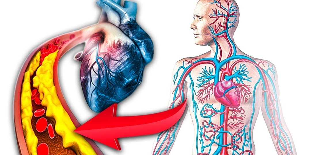 Атеросклероз: от первых признаков к успешному лечению — как остановить бляшки, не дожидаясь инфаркта