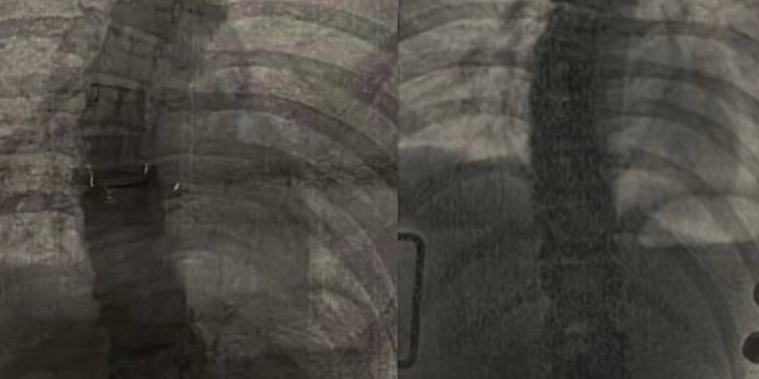 НОВАЯ ЭФФЕКТИВНАЯ МЕТОДИКА ЛЕЧЕНИЯ СКОЛИОЗА