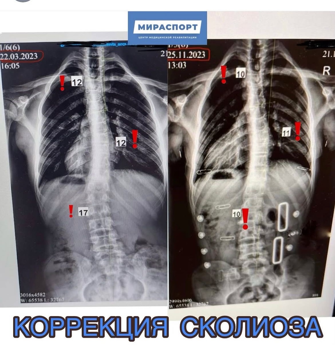 Уменьшение углов Кобба