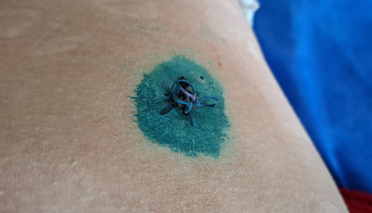 Шов после лапароцентеза. До