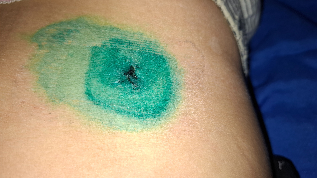 И после снятия шва