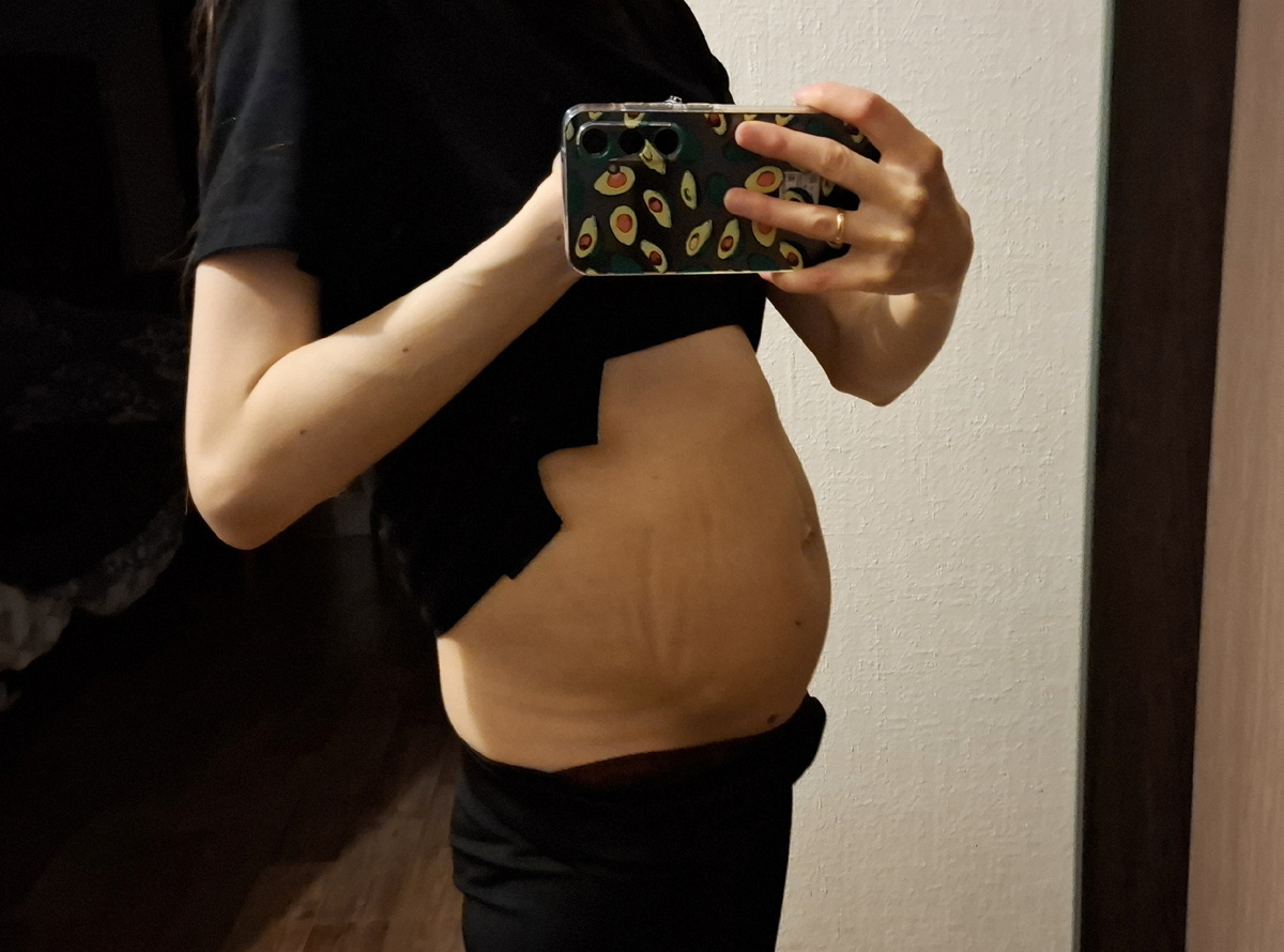 Живот 24 мая (следы от бандажа)