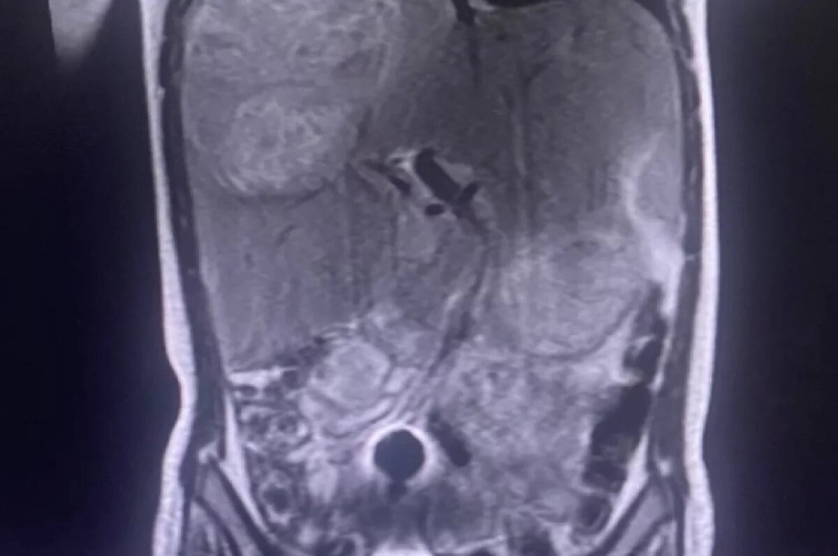    В Челябинске спасли 4-летнего ребенка с огромным абсцессом печени